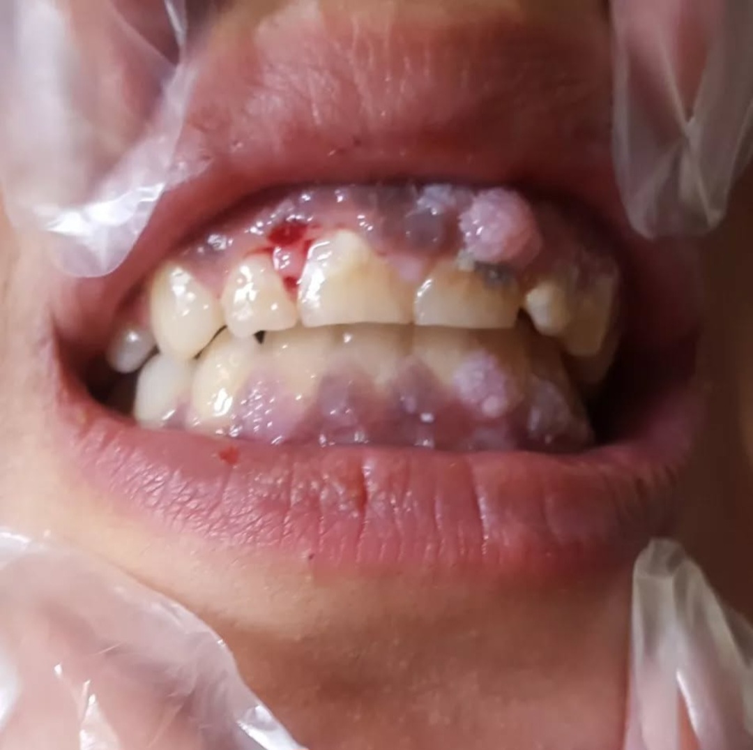 آزمایش HPV دهانی؛ چه زمانی لازم است و چه کسانی باید تست بدهند؟