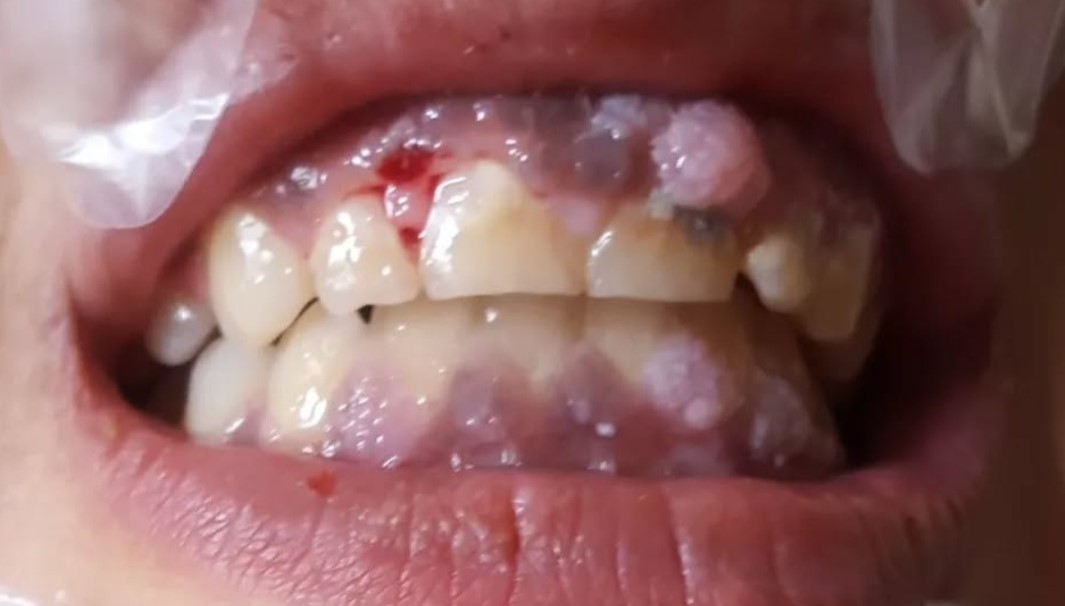 آزمایش HPV دهانی؛ چه زمانی لازم است و چه کسانی باید تست بدهند؟